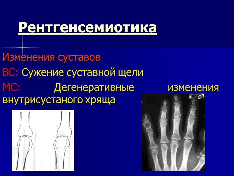 Рентгенсемиотика Изменения суставов ВС: Сужение суставной щели МС: Дегенеративные изменения внутрисустаного хряща